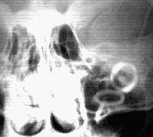 Jay Kats' Brain Implants XRAY