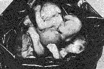 Photograph of aborted babies in 
a garbage can