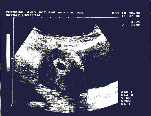 Ultrasound of implant